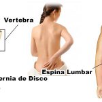 Cirugía Endoscópica De Disco